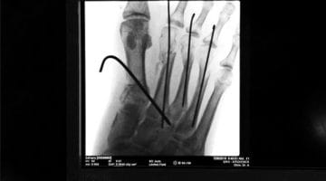 X-Ray of a broken foot.