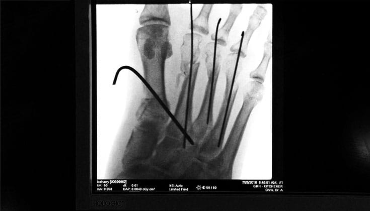 X-Ray of a broken foot.